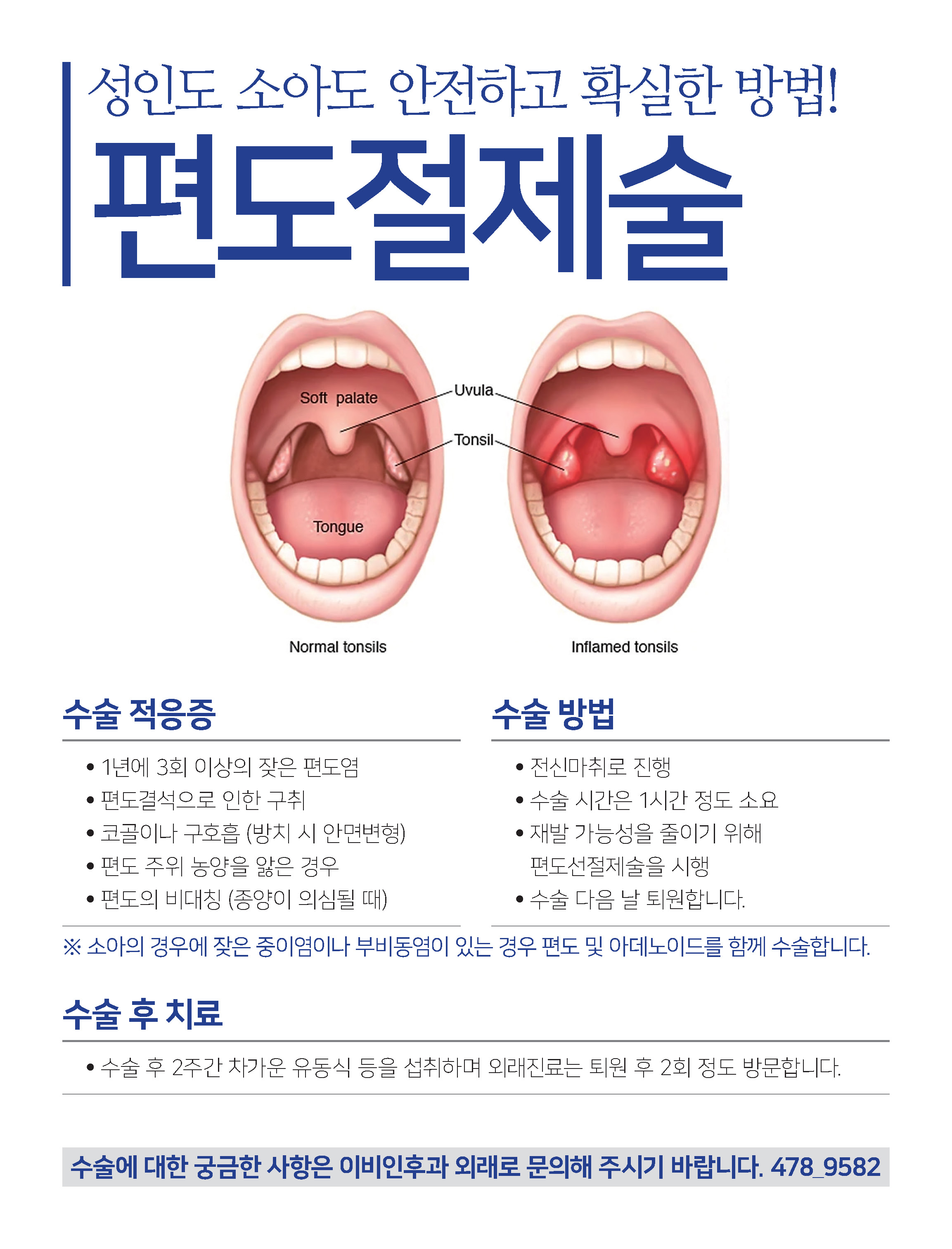 편도절제술 : Tonsillectomy 첨부 이미지
